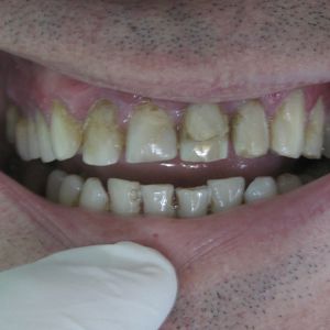 Cercon Zirconia Ceramics 6