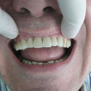 Cercon Zirconia Ceramics 7