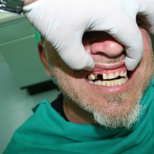 Cercon Zirconia Ceramics 1