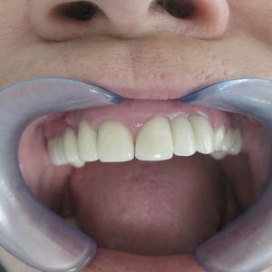 Cercon Zirconia Ceramics 8