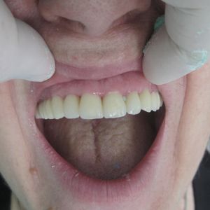 Cercon Zirconia Ceramics 9