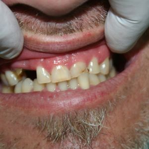 Cercon Zirconia Ceramics 2