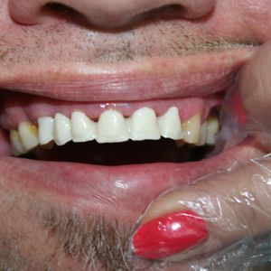 Cercon Zirconia Ceramics 3