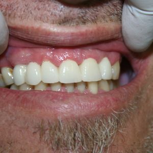 Cercon Zirconia Ceramics 4