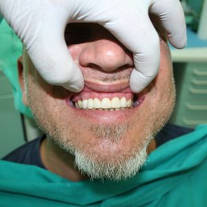 Cercon Zirconia Ceramics 5