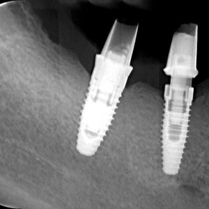 Dental Implants 1