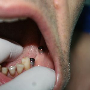 Dental Implants 5