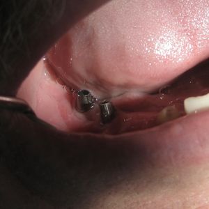 Dental Implants 2