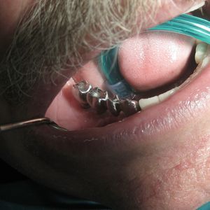 Dental Implants 3