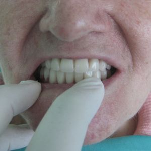 Dental Prostheses 2