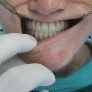 Dental Prostheses 3