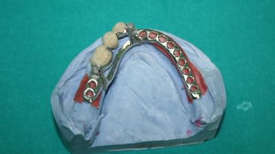 Combination Prosthesis